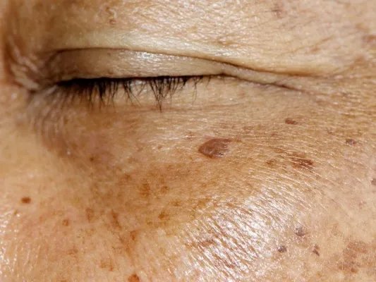 脸颊长斑的原因