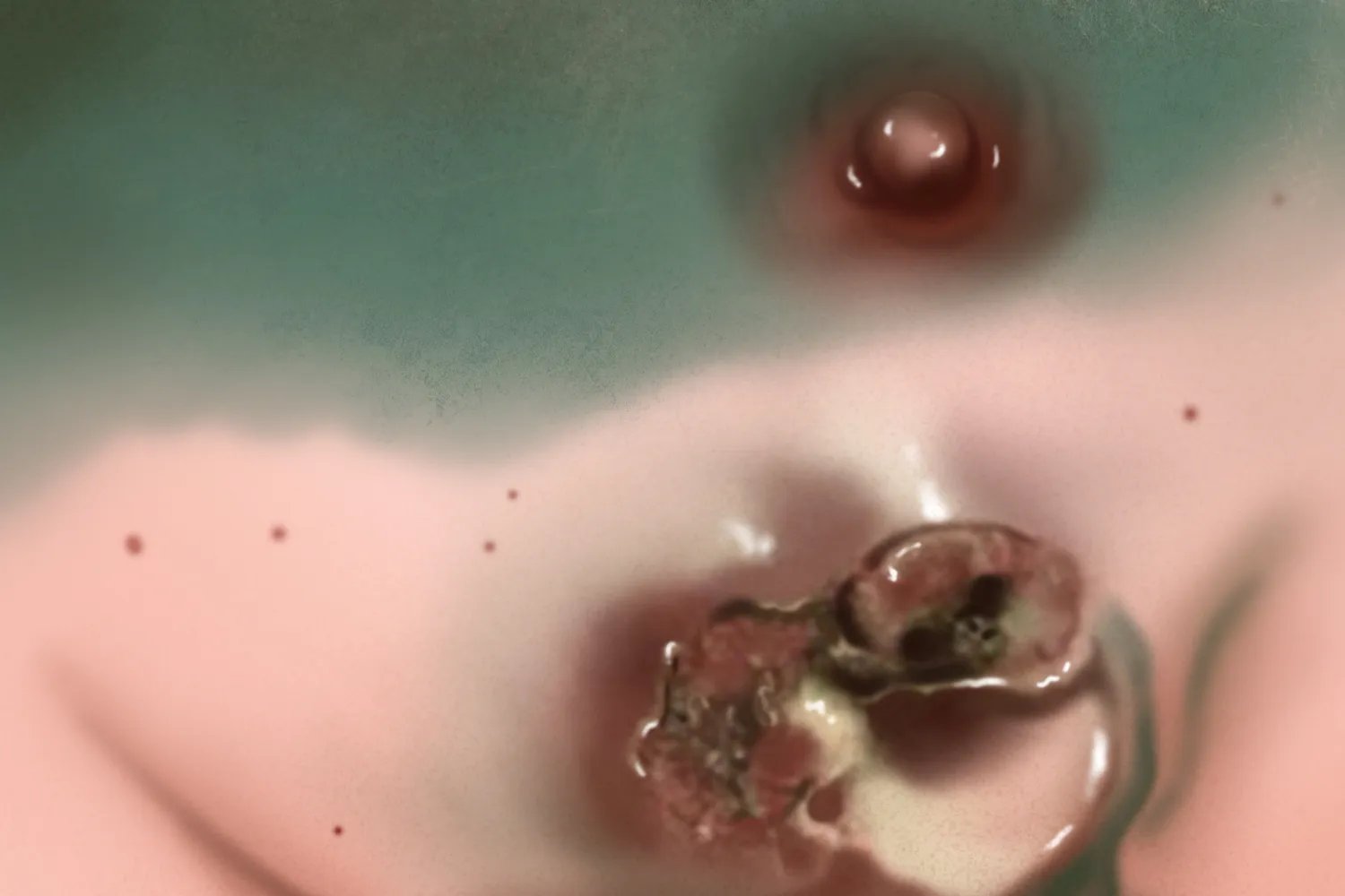 乳腺癌与正常图片