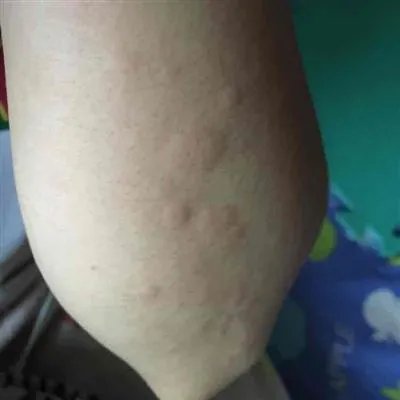 麻疹危害及症状是什么