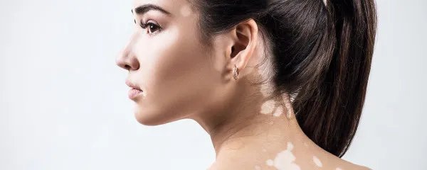 白癜风会传染吗