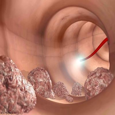 得了胆囊结石怎么办