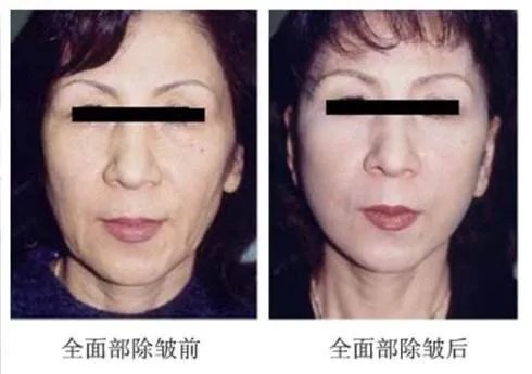 激光除皱手术多少钱