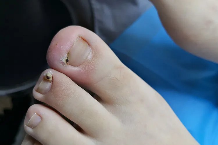 甲沟炎初期图片