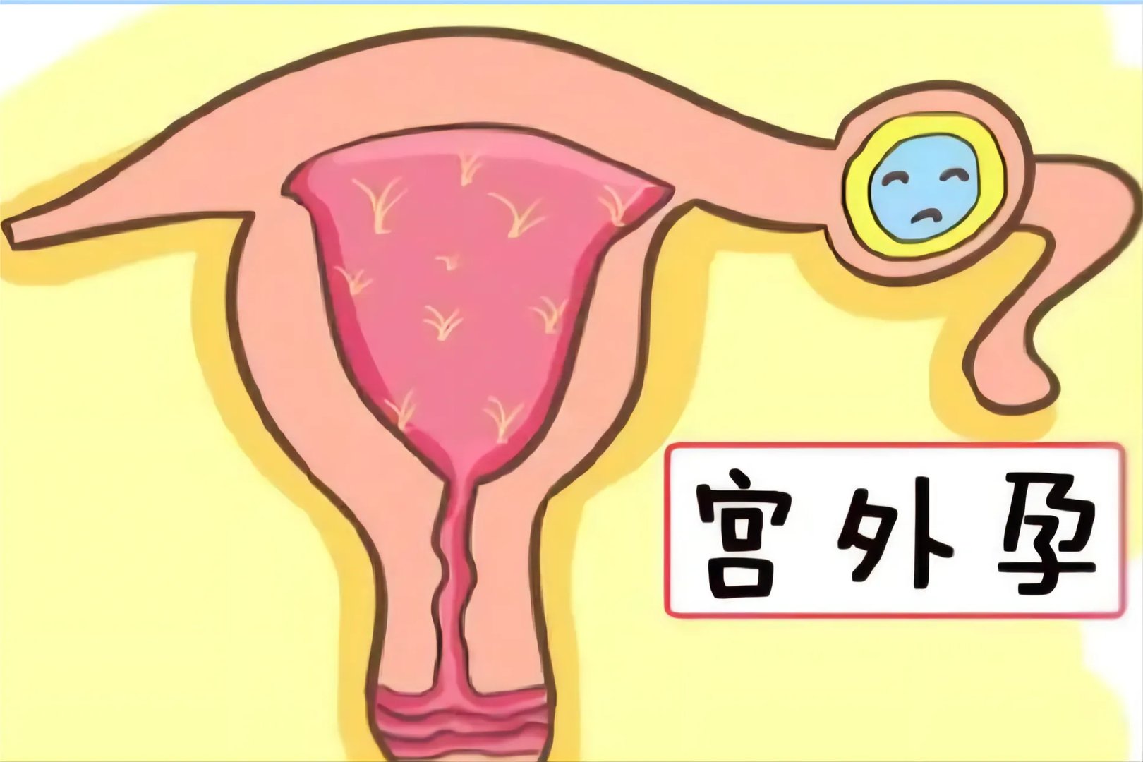 宫外孕的位置图