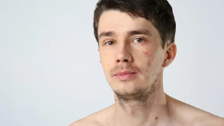 胎记应该怎样护理比较好