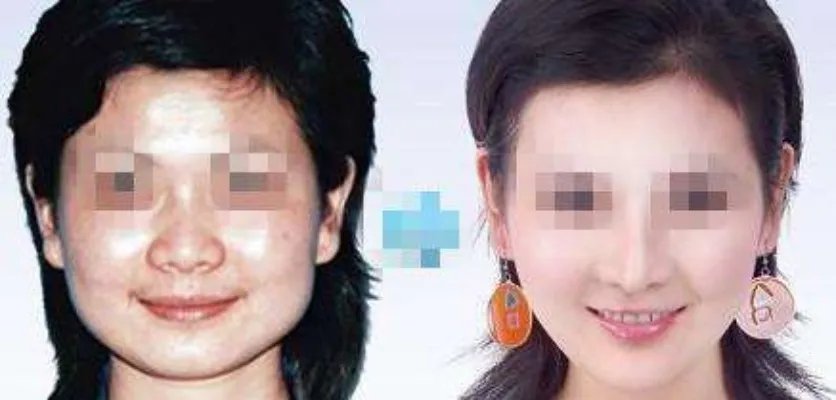 彩光嫩肤要多少钱