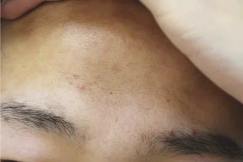 激光祛痘效果好吗