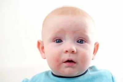 宝宝脸上起红疙瘩是怎么回事