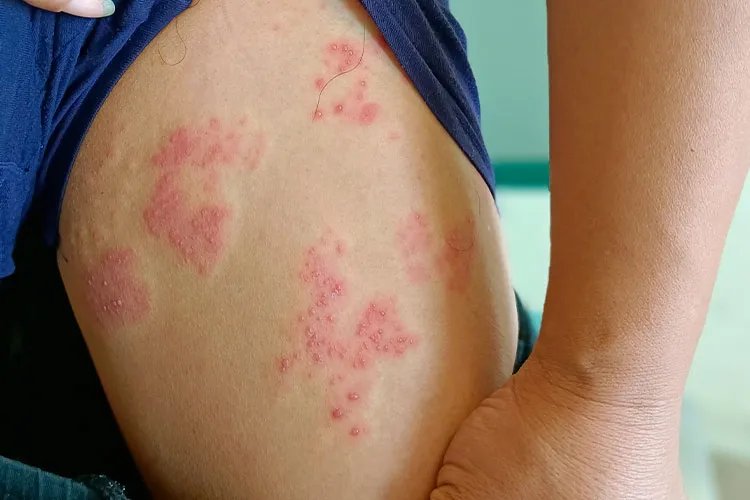 轻度带状疱疹图片