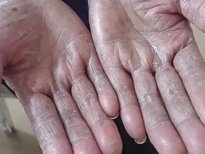 3级手足综合征症状图片