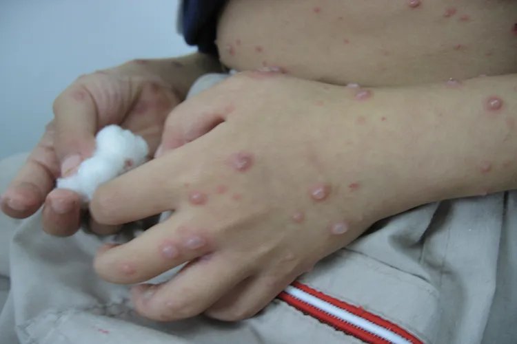 怎么判断是不是水痘图片