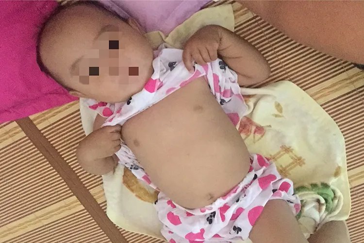 小孩鸡胸和正常胸图片