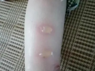 蠓虫叮咬引起的皮肤反应大水疱图片