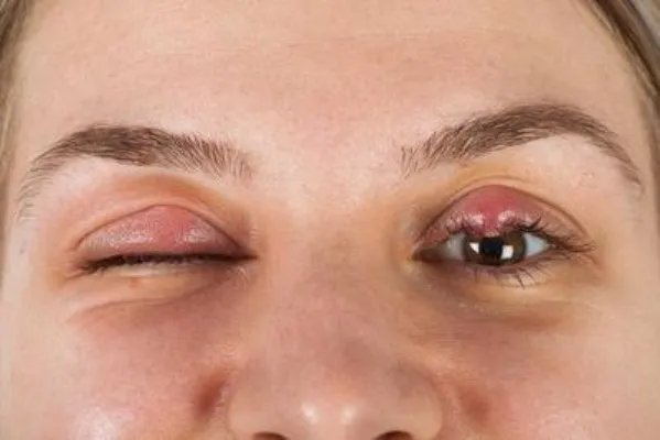 上眼睑松弛如何矫正