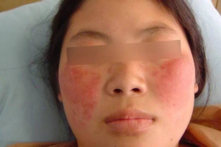 女性红斑狼疮早期症状图片