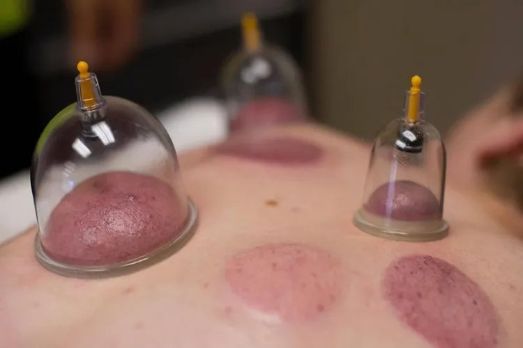 拔罐的颜色代表什么图解