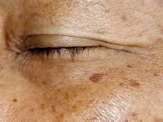 怎么防止老年斑