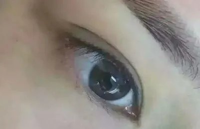 外切去眼袋要多少钱