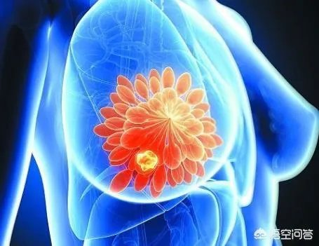 李咏得了什么病？