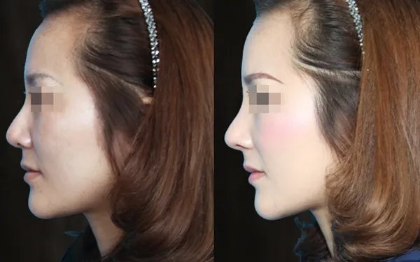 隆鼻注射价格多少