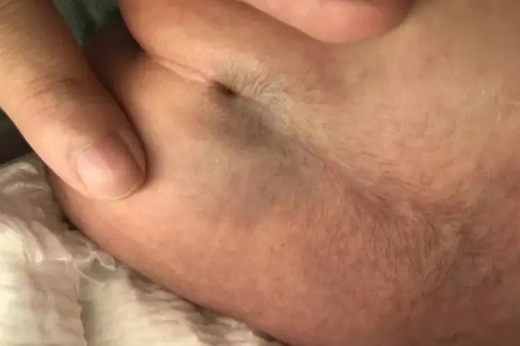 新生儿肛门上方凹下去一个窝图片