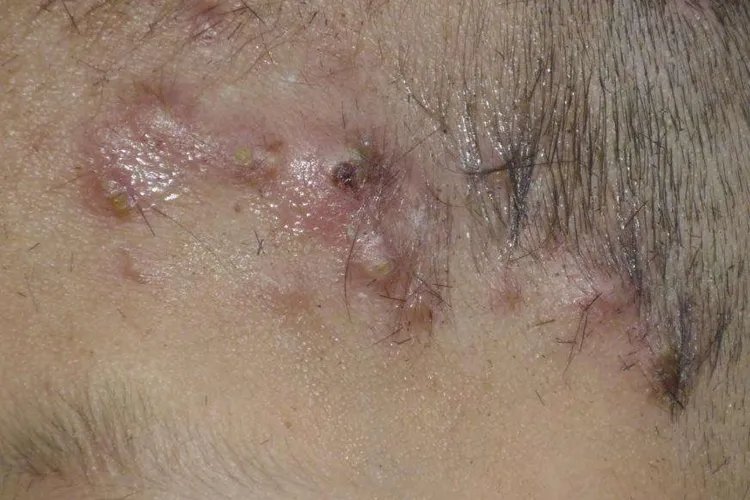 严重毛囊炎图片