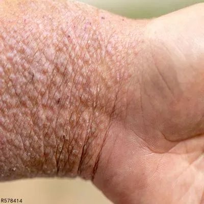 接触性皮炎的症状有哪些 从四个症状快速辨别接触性皮炎