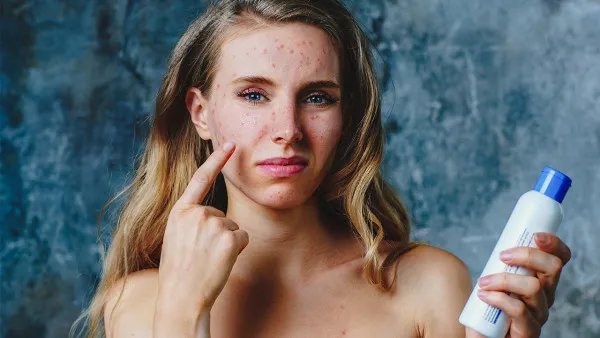 怎样祛黑头粉刺