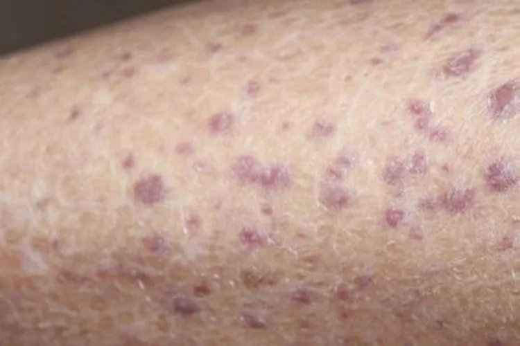 白血病早期红疹图片