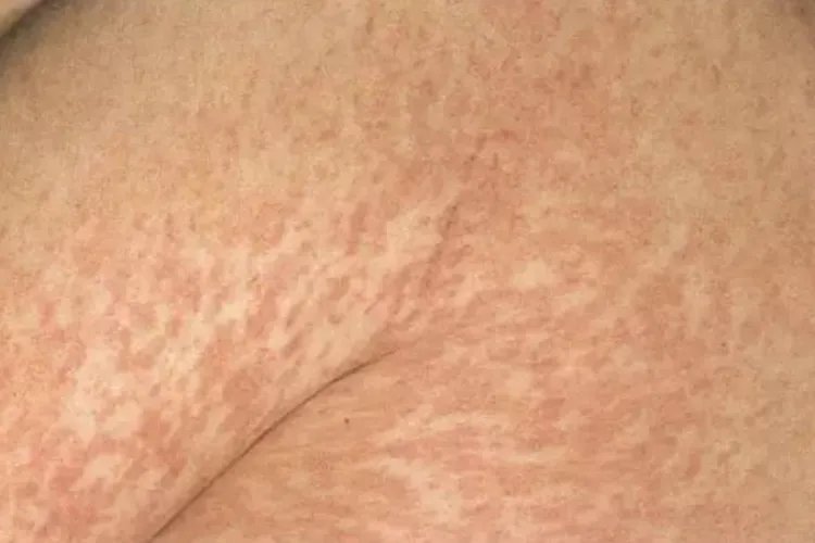 麻疹荨麻疹图片