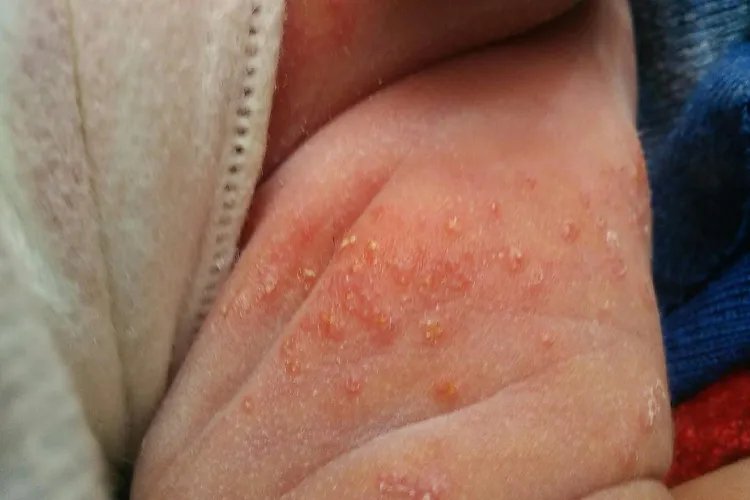 大腿内侧湿疹和股癣图片