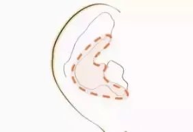 爱美?来看看如何隆鼻吧!