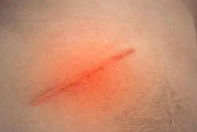 手术疤痕应该如何去除