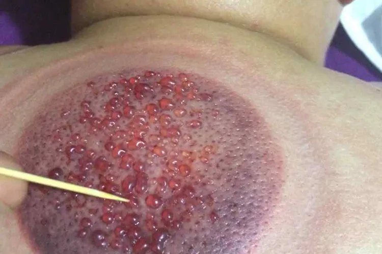 拔罐的颜色代表什么图解