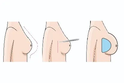 隆胸手术全过程图