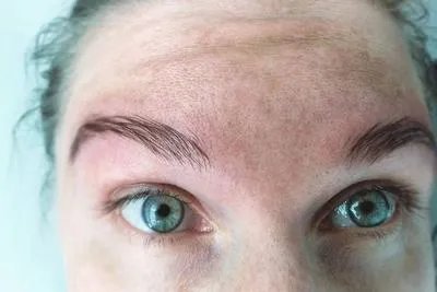 晒斑要怎么去除