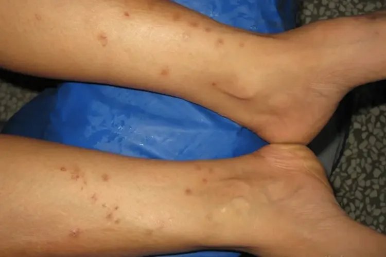 血吸虫病的图片