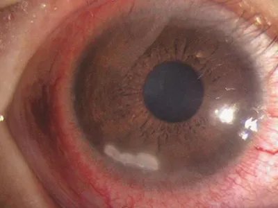 细菌性角膜炎症状图片