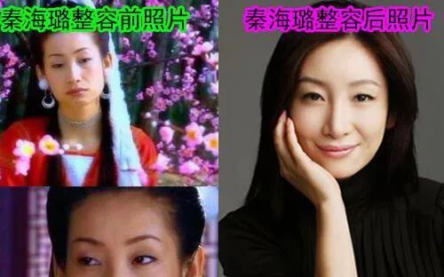 秦海璐整容前后照片对比：大方承认自己整过容