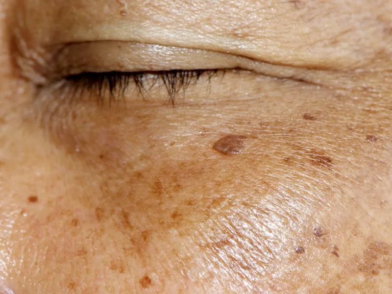 中医祛斑最好的方法