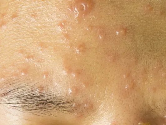 水痘疤痕出现的原因