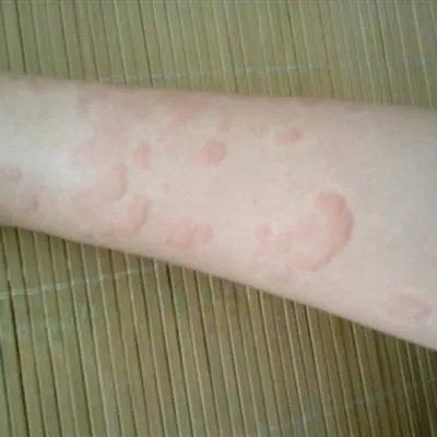 麻疹危害及症状是什么