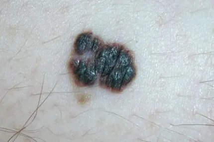 恶性黑色素瘤图片