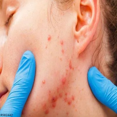 去面部痤疮疤痕的办法有什么