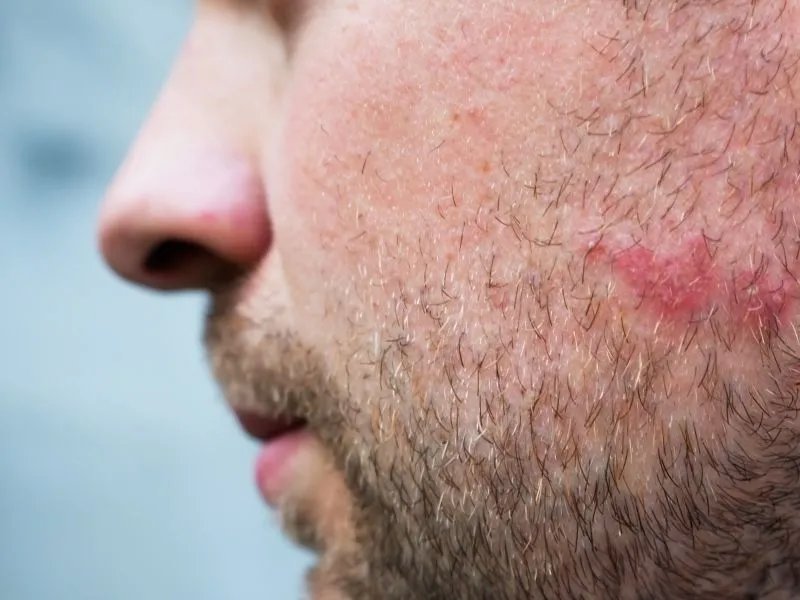 男士祛痘印有哪些方法