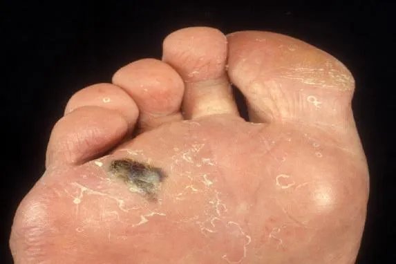 恶性黑色素瘤图片