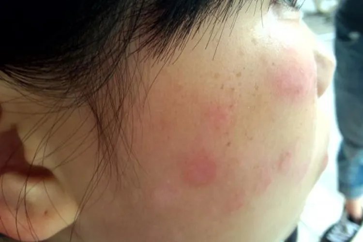 红斑狼疮脸上红斑图片