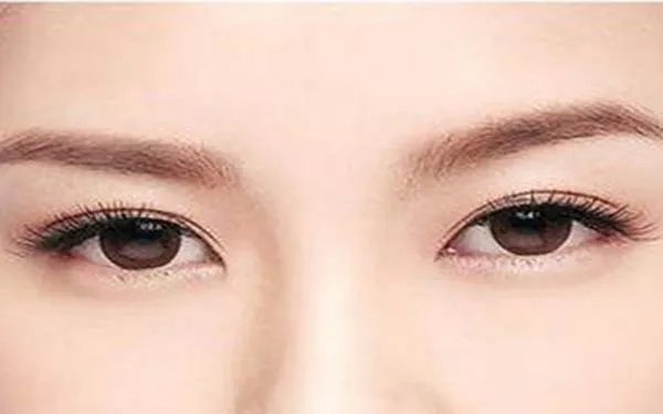 失败双眼皮修复