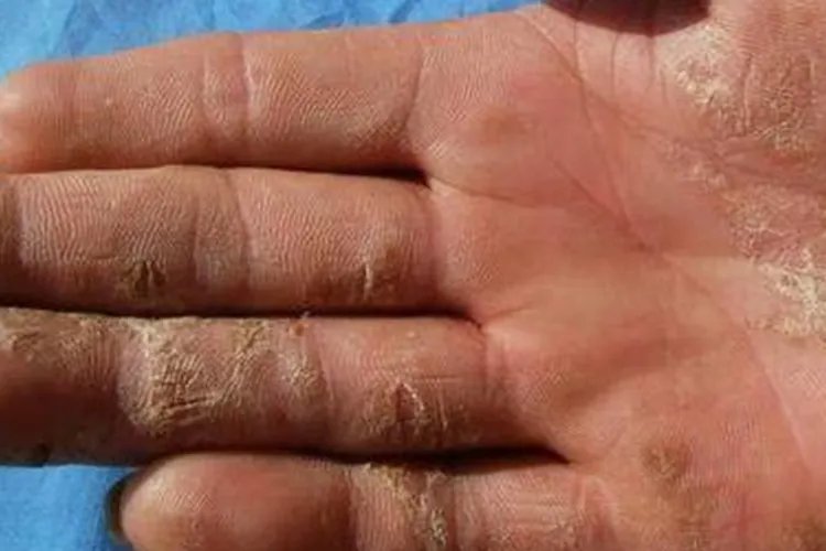 甲醛会导致身体出现哪些状况图片