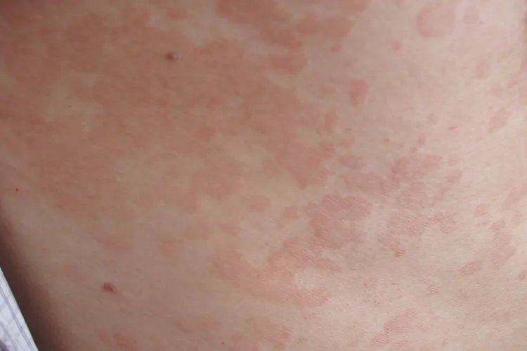 片状皮疹图片